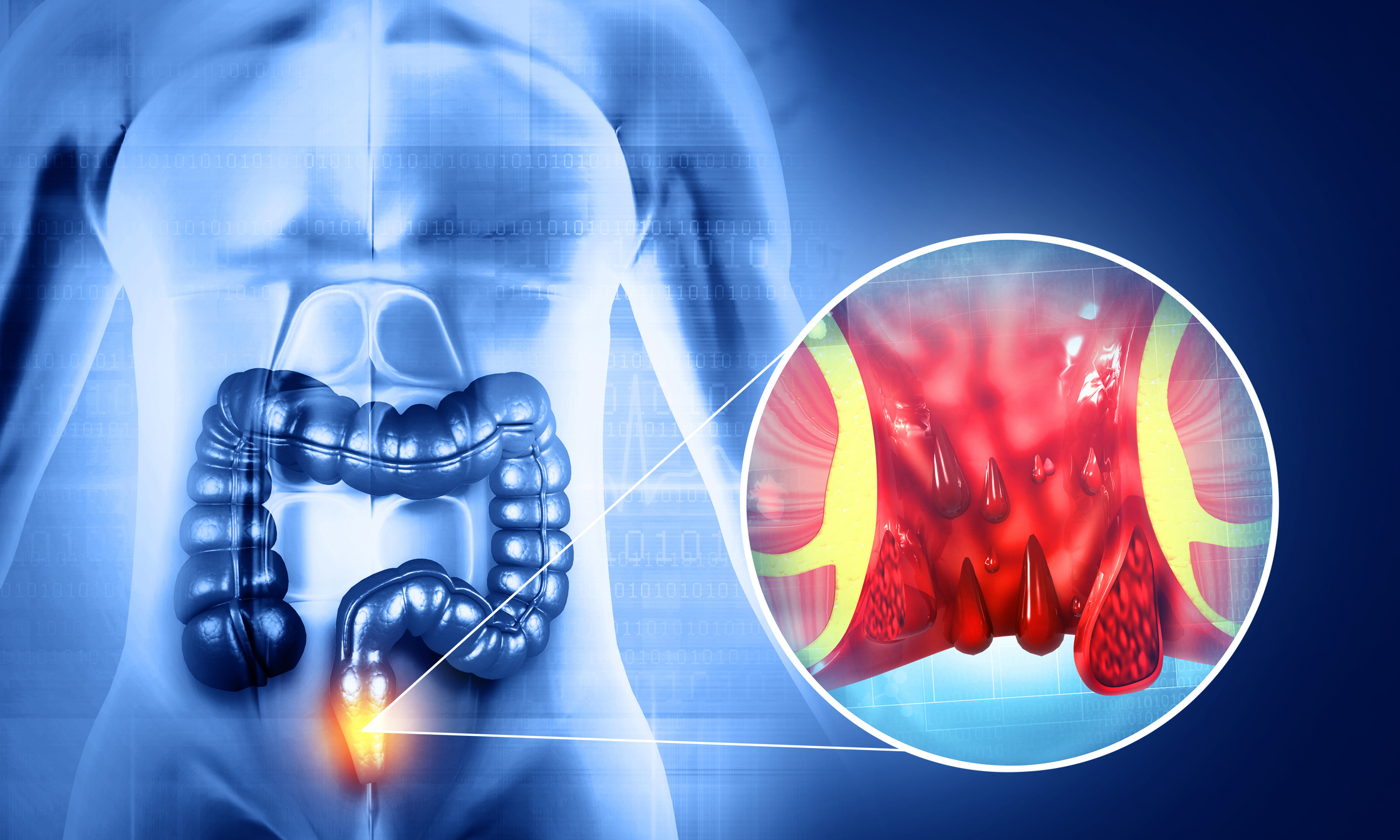 Hemoroid (Basur) Nedir?