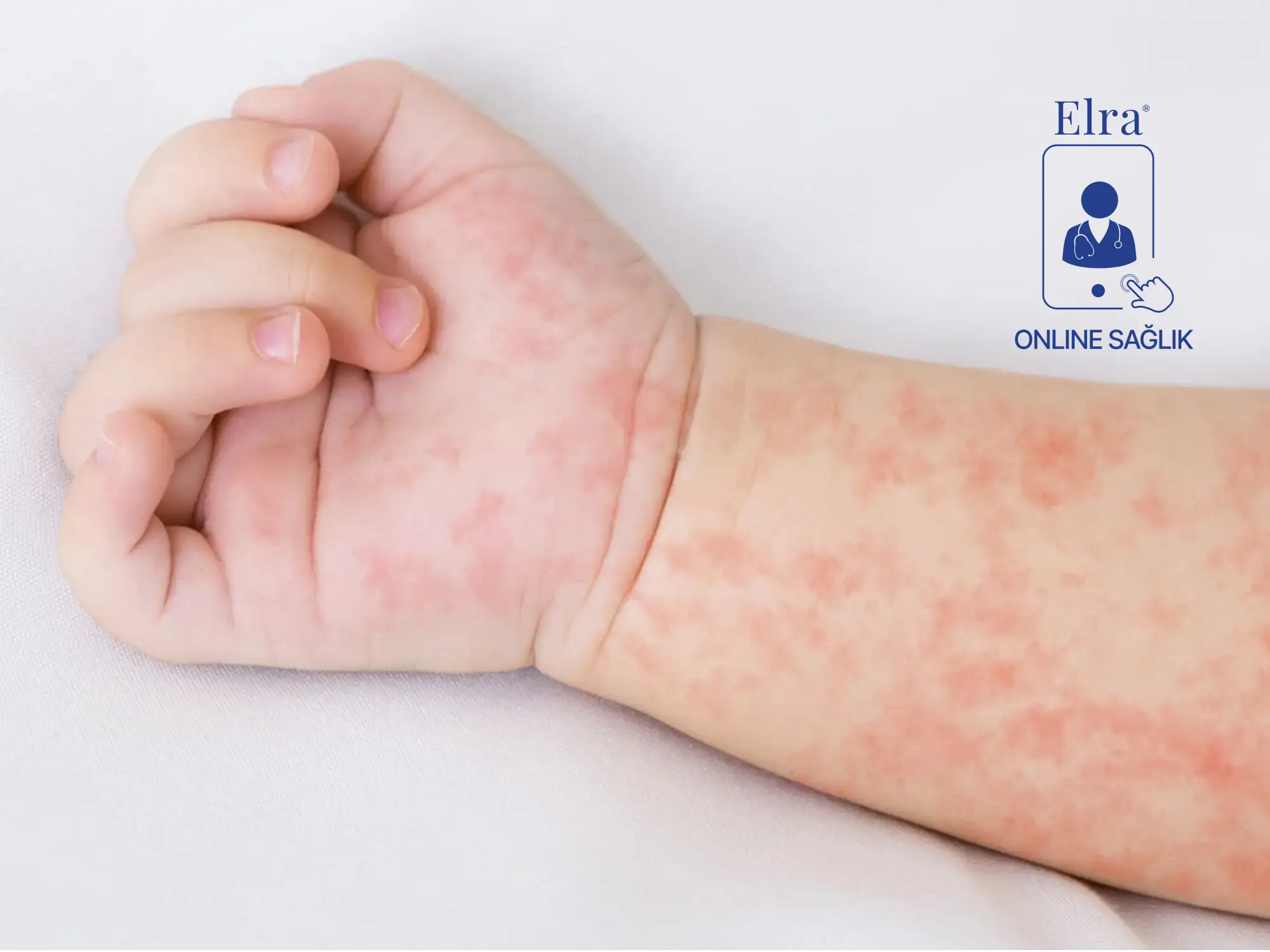 Altıncı Hastalık (Roseola infantum)
